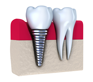 Dental Implants Peoria AZ